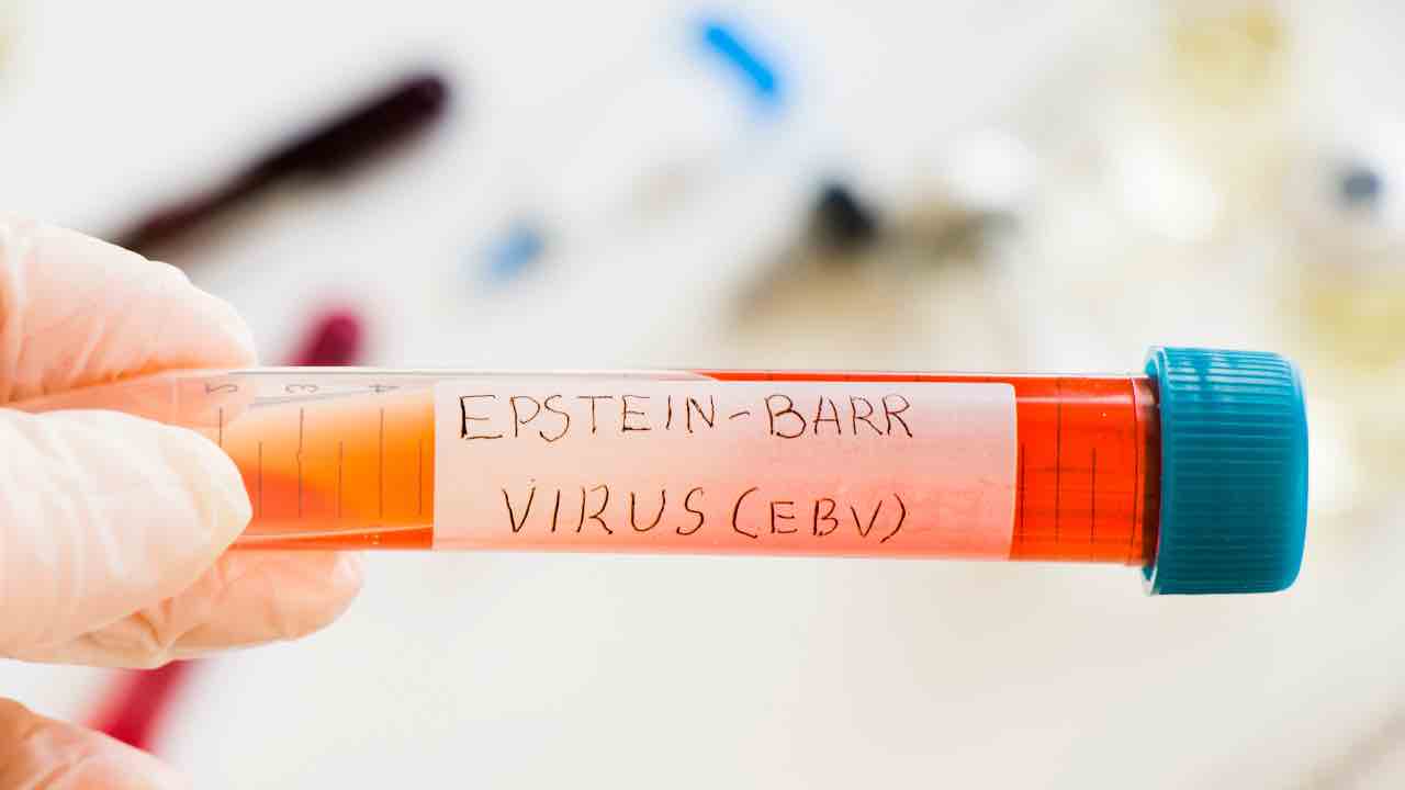 mononucleosi virus epstein barr