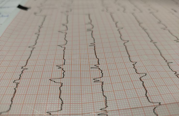 elettrocardiogramma cuore cardiaco